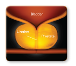 Enlarged Prostate - BPH